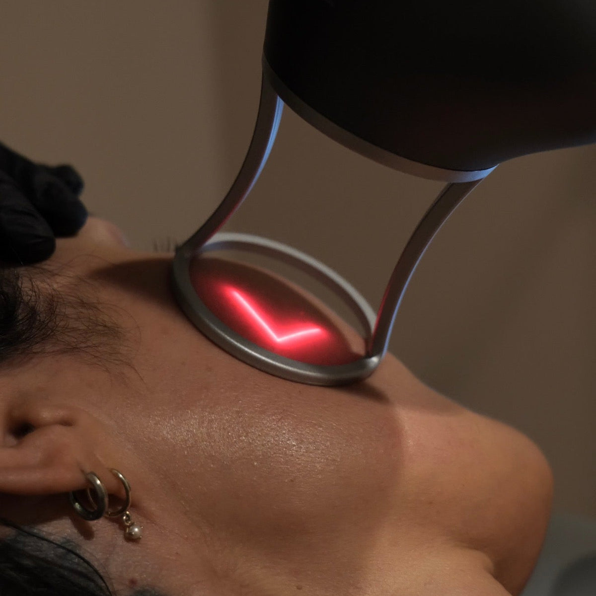 Founders Club Laser Facial